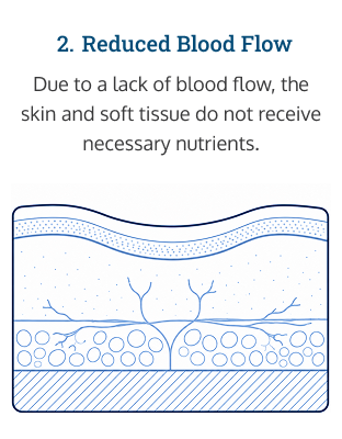 Diagram of how pressure sores form: step 2: blood flow to tissue is stalled or halted.