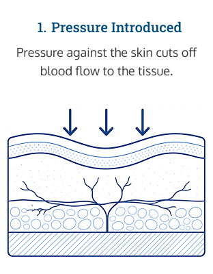 Diagram of how pressure sores form: step 1: pressure is introduced.