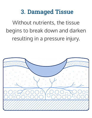 Diagram of how pressure sores form: step 3: damage tissue