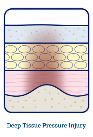 Deep tissue wound diagram
