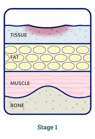 Stage 1 wound diagram
