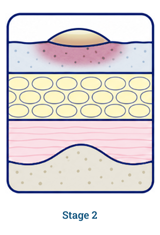 Stage 2 wound diagram