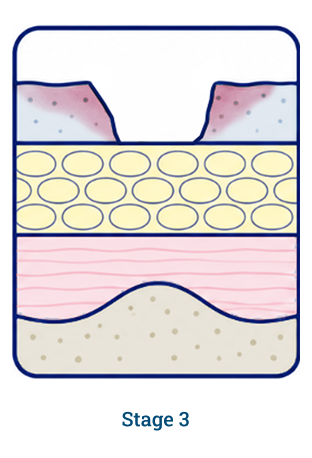 Stage 3 wound diagram
