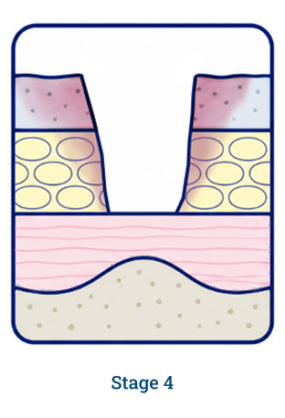 Stage 4 wound diagram