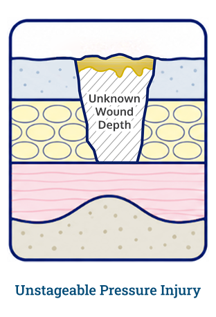 unstageable wound diagram